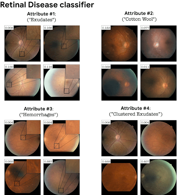 망막 이미지의 DME(당뇨병성 황반부종) 분류기에 대해 자동으로 감지된 속성이다.(사진=구글 블로그)