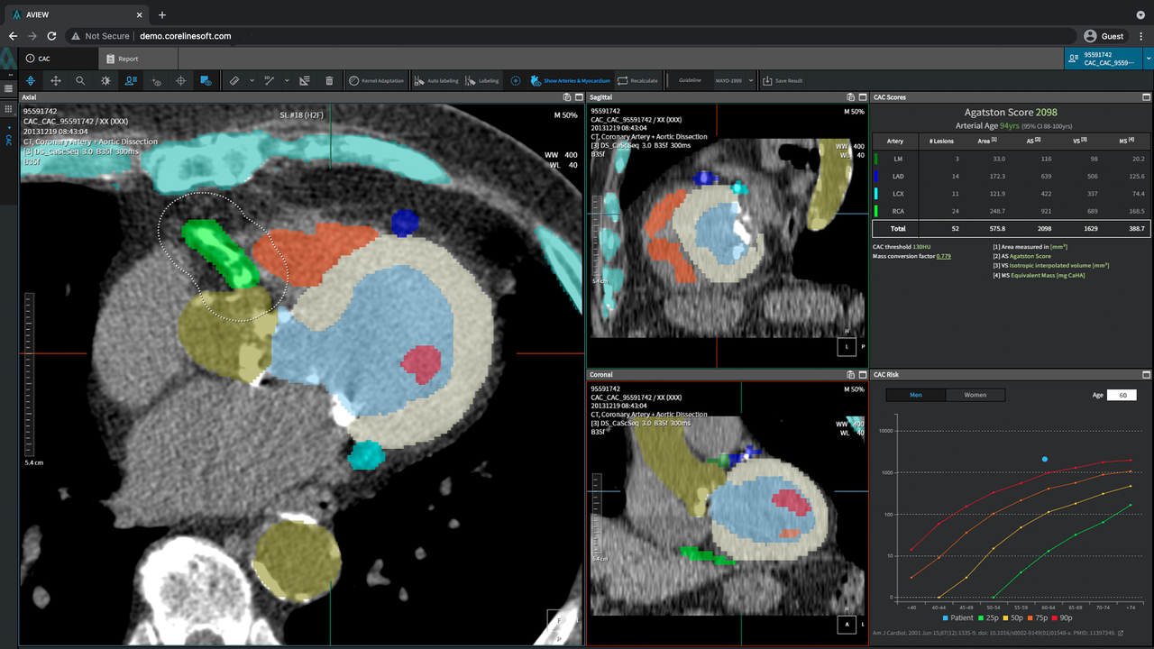코어라인소프트가 관상동맥 석회화 자동 진단솔루션 '에이뷰 씨에이씨(AVIEW CAC)'를 개발했다. (사진=코어라인소프트)