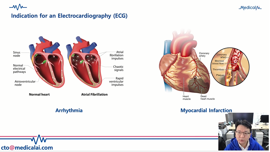 메디컬 AI는 전에는 ECG로 검출할 수 없었던 심부전, 심실세농, 빈혈 등 다양한 질병을 검진할 수 있는 기술을 개발했다.(사진=메디컬 AI)