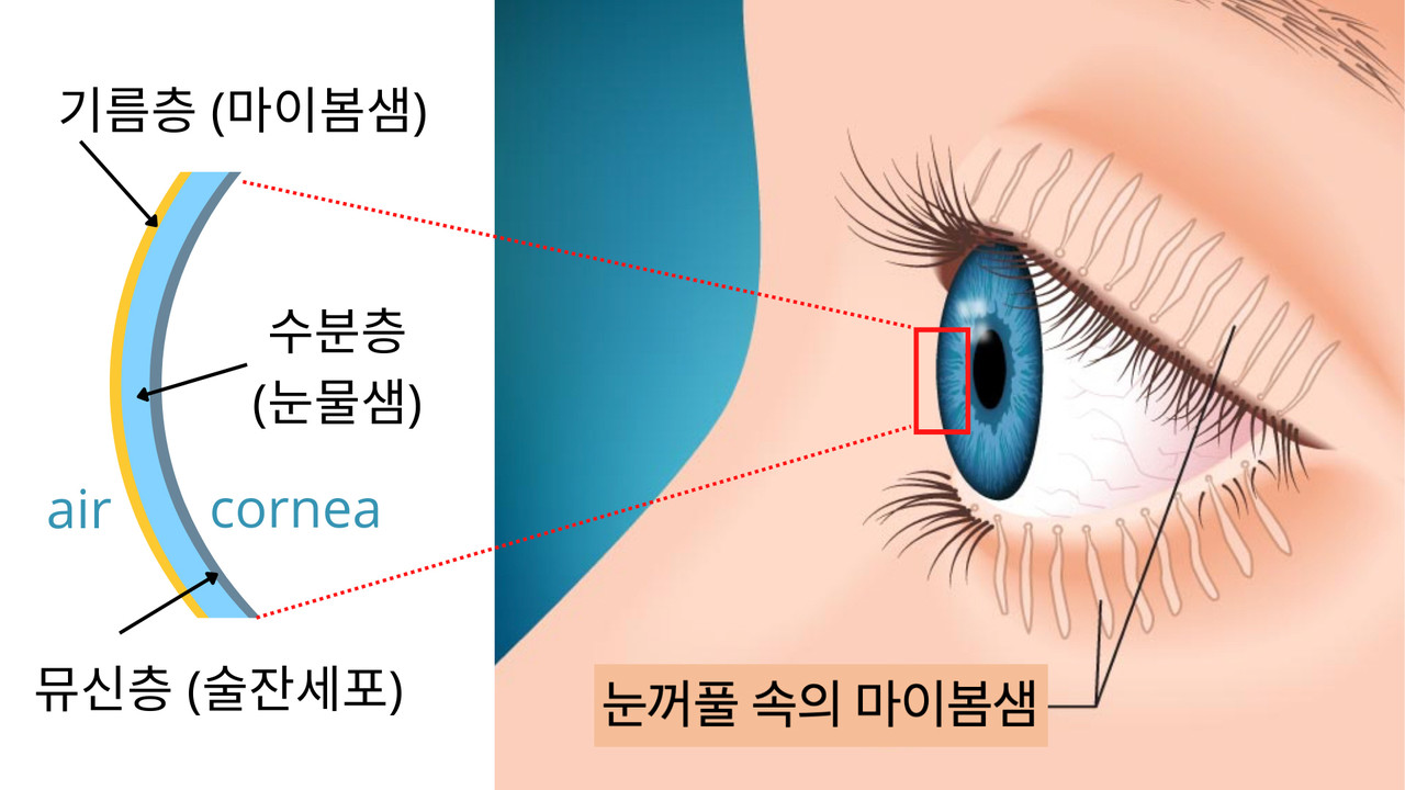 눈꺼풀 속 마이봄샘과 눈물층 설명도. 눈물막은 크게 ▲뮤신층(mucin layer) ▲수분층(aqueous layer) ▲기름층(lipid layer)으로 구성돼 있다. 이 중 눈을 많이 사용하는 현대인에게 가장 많이 발생하는 질환이 바로 증발성 안구건조증이다. 이는 눈꺼풀에 있는 마이봄샘이 기름층을 생성해 눈물막에 있는 수분이 공기 중으로 증발하지 않도록 해야 하는데 이 기능이 저하되거나 마이봄샘이 소실돼 발생한다. (사진=지스트 제공).