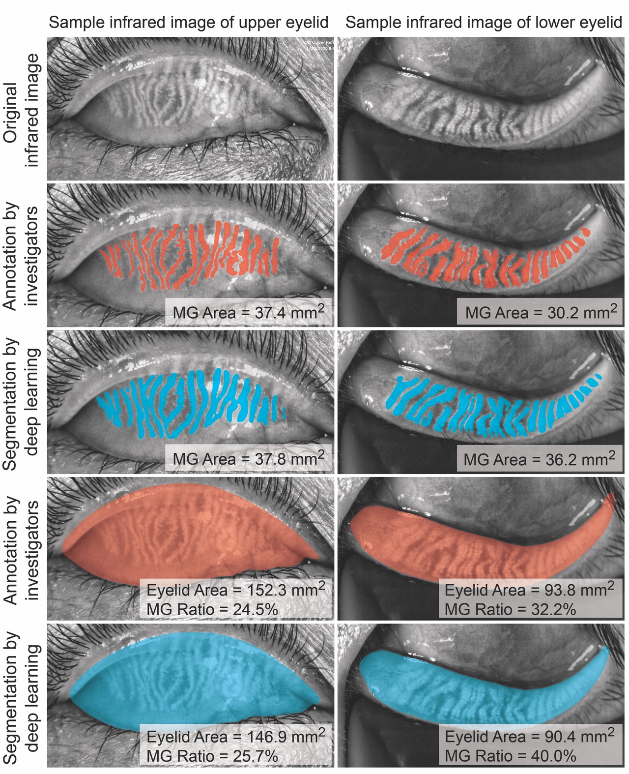 딥러닝과 연구자의 눈꺼풀 마이봄샘 영역 표기 비교. 윗눈꺼풀(좌)과 아랫눈꺼풀(우)의 마이봄샘 영역 및 눈꺼풀 영역을 딥러닝(파란색)과 임상의(붉은색)가 표시했다. 사진은 딥러닝 결과가 전문가의 분석과 일치함을 보여준다. (사진=지스트 제공).