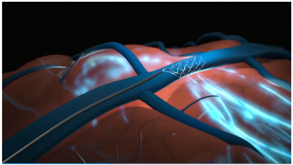 싱크론은 두개골을 절개할 필요가 없는 혈관 내 시술로 경정맥을 통해 뇌의 운동 피질 내에 두뇌-컴퓨터 인터페이스 칩을 이식한다.(사진=싱크론)