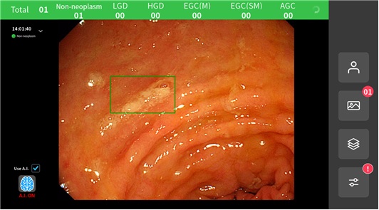 인공지능 기반 위내시경 판독 프로그램 예시(사진=아이도트)