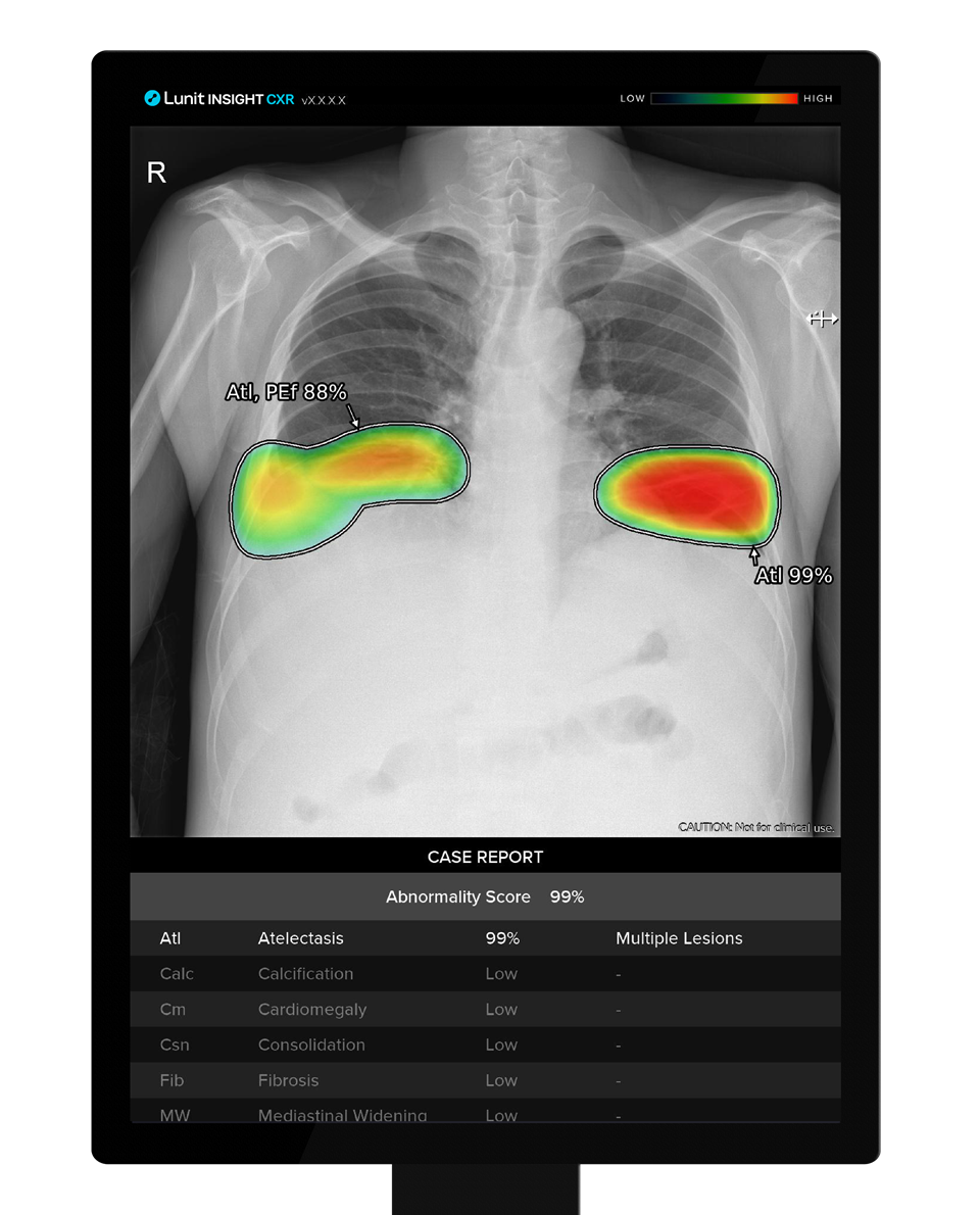 루닛 인사이트 CXR 관련 이미지 (사진=루닛)