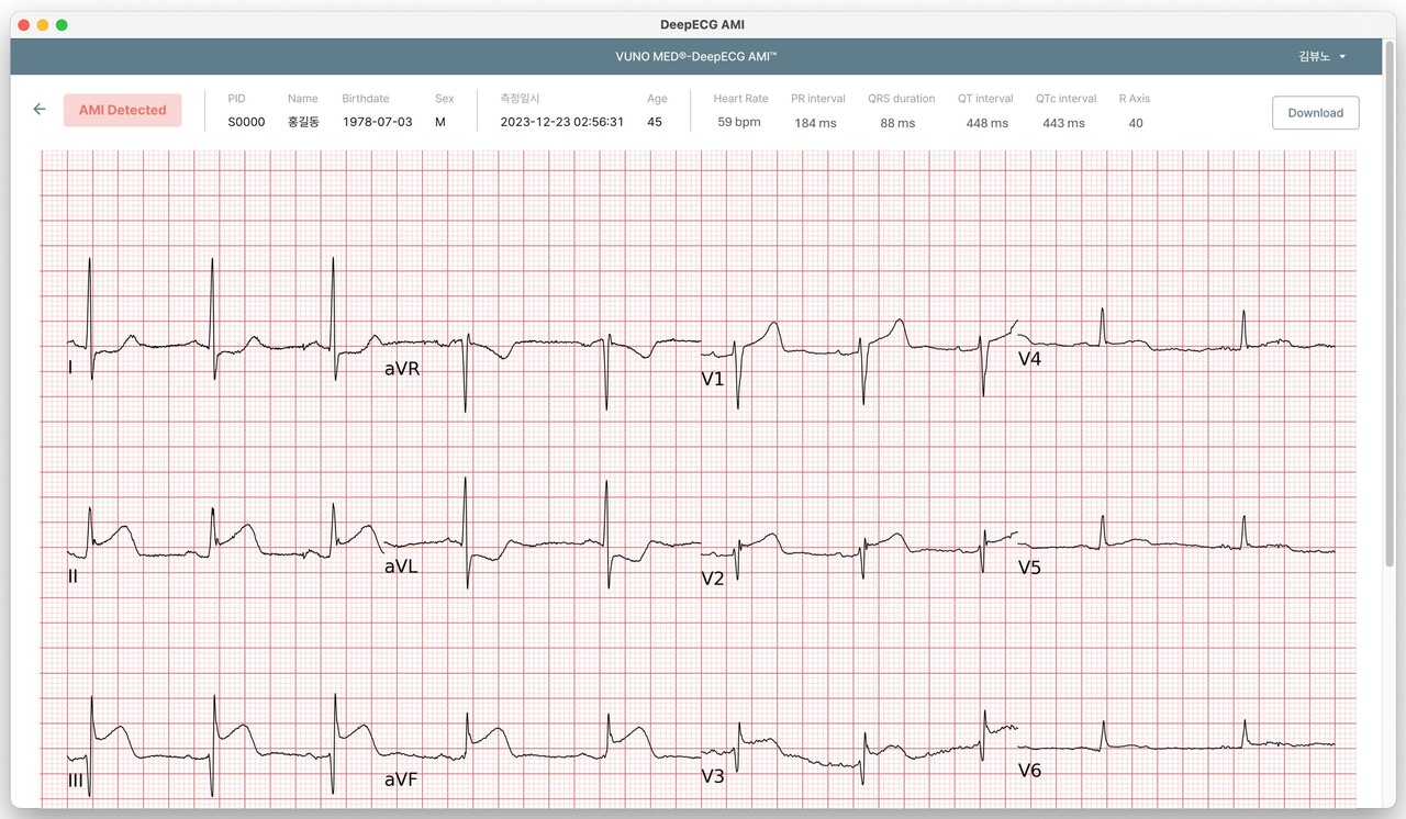 뷰노메드 딥ECG AMI 운영화면 예시 (사진=뷰노)