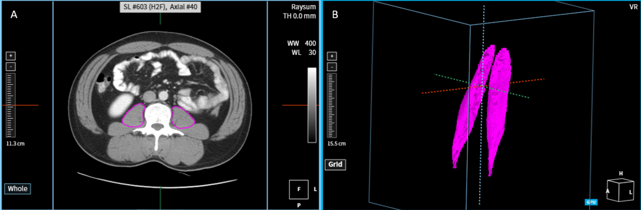 Psoas muscle estimated by AI from CT data (Photo = Coreline Soft)
