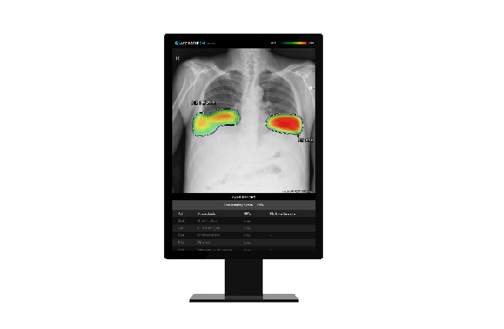 루닛 인사이트 CXR (사진=루닛)