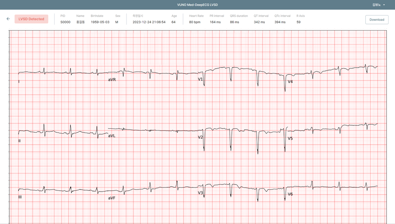 뷰노메드 딥ECG LVSD 운영화면 예시 (사진=뷰노)