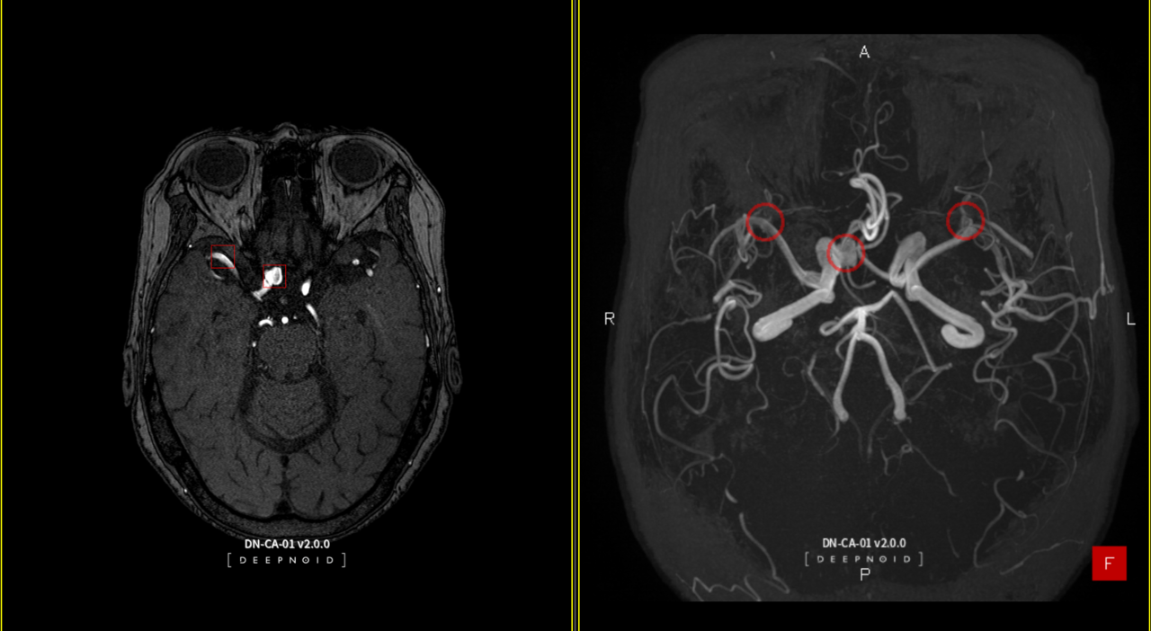 딥뉴로 판독 이미지 (사진=딥노이드)
