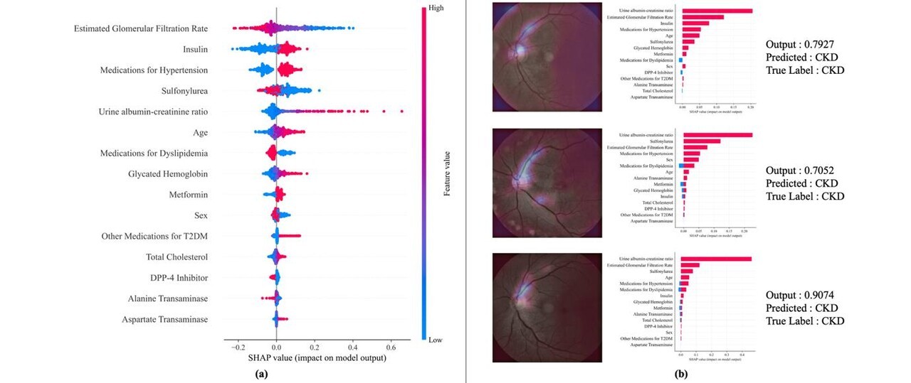 당뇨 합병증 예측 AI의 ‘주요 위험 인자 기여도 분석’ 시각화 결과 (사진=경희대학교)